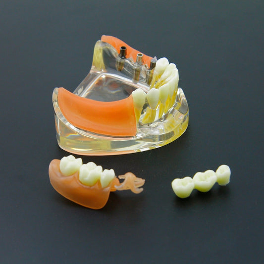 Dental Implant Restoration Teeth Model Removable Bridge Denture