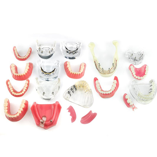 Dental Overdenture Teeth Model Removable Teaching Study